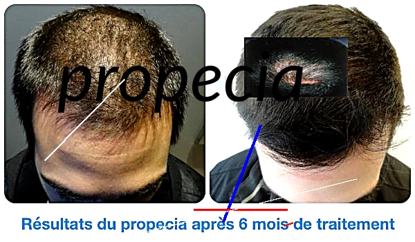 Prix propecia finasteride